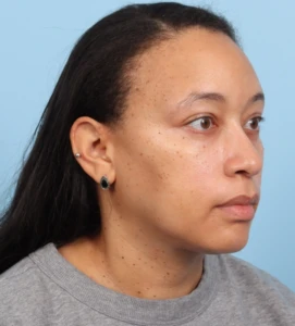 Lower Blepharoplasty 2 A