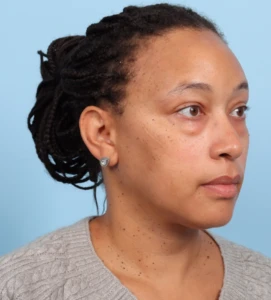 Lower Blepharoplasty 2 B