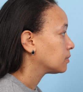 Lower Blepharoplasty 3 A