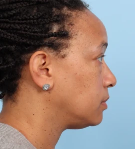 Lower Blepharoplasty 3 B
