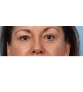 Lower Blepharoplasty 5 A