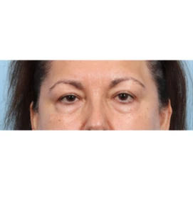 Lower Blepharoplasty 5 B