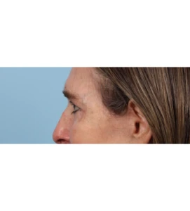 Lower Blepharoplasty 6 A