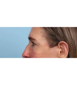 Lower Blepharoplasty 6 B