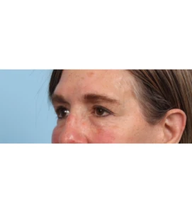 Lower Blepharoplasty 7 B