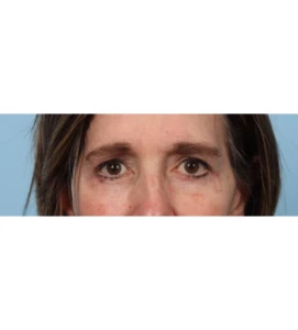 Lower Blepharoplasty 9 A