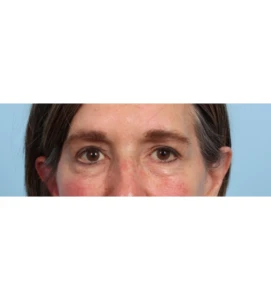 Lower Blepharoplasty 9 B