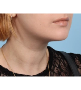 Neck Contouring 1 A