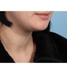 Neck Contouring 1 B
