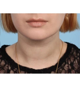 Neck Contouring 2 A