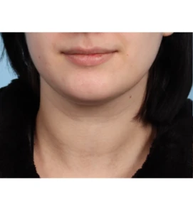 Neck Contouring 2 B