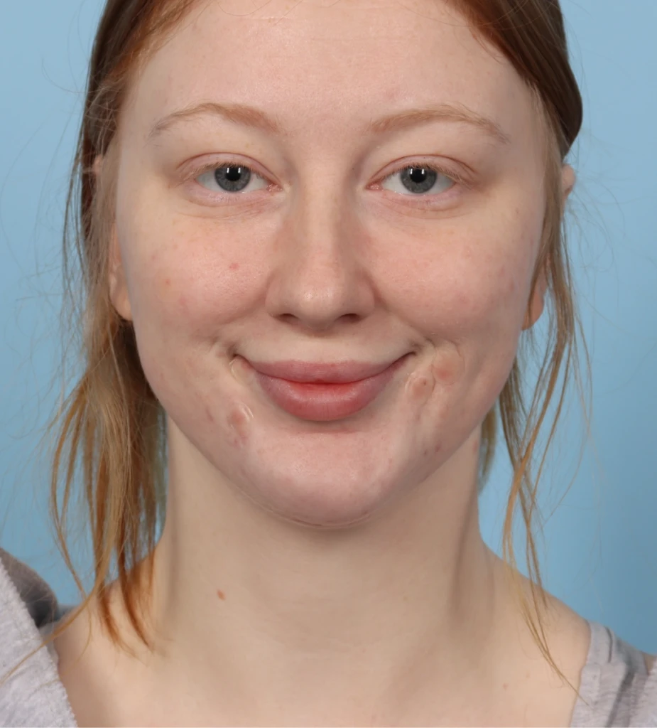 Neck Contouring 3 A