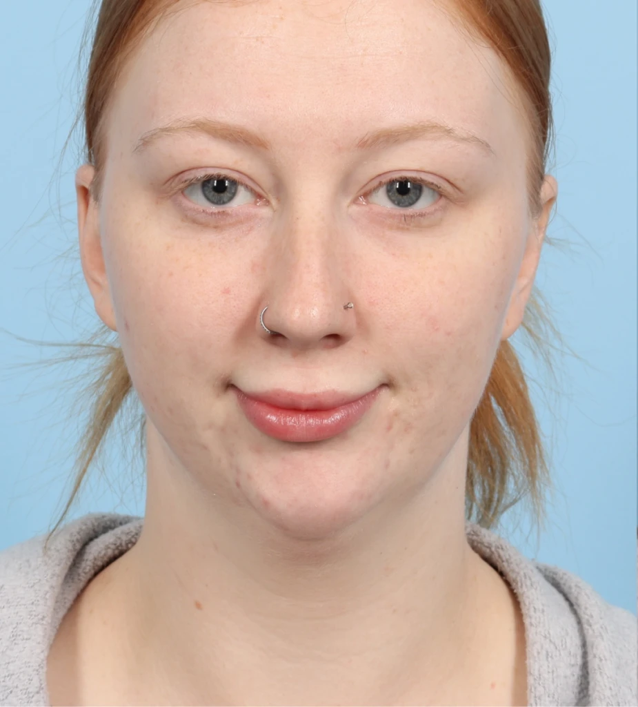 Neck Contouring 3 B