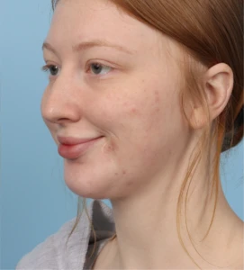 Neck Contouring 4 A