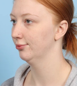 Neck Contouring 4 B