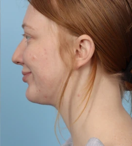 Neck Contouring 5 A
