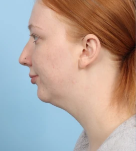 Neck Contouring 5 B