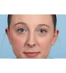 Otoplasty 2 A