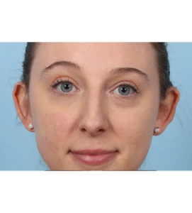 Otoplasty 2 B
