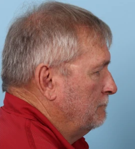 Rhinophyma 1-1 A