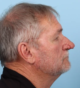 Rhinophyma 1-1 B