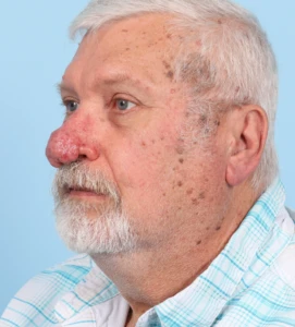 Rhinophyma 2-1 B