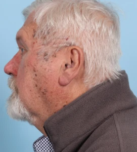 Rhinophyma 2-2 A