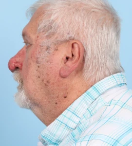 Rhinophyma 2-2 B