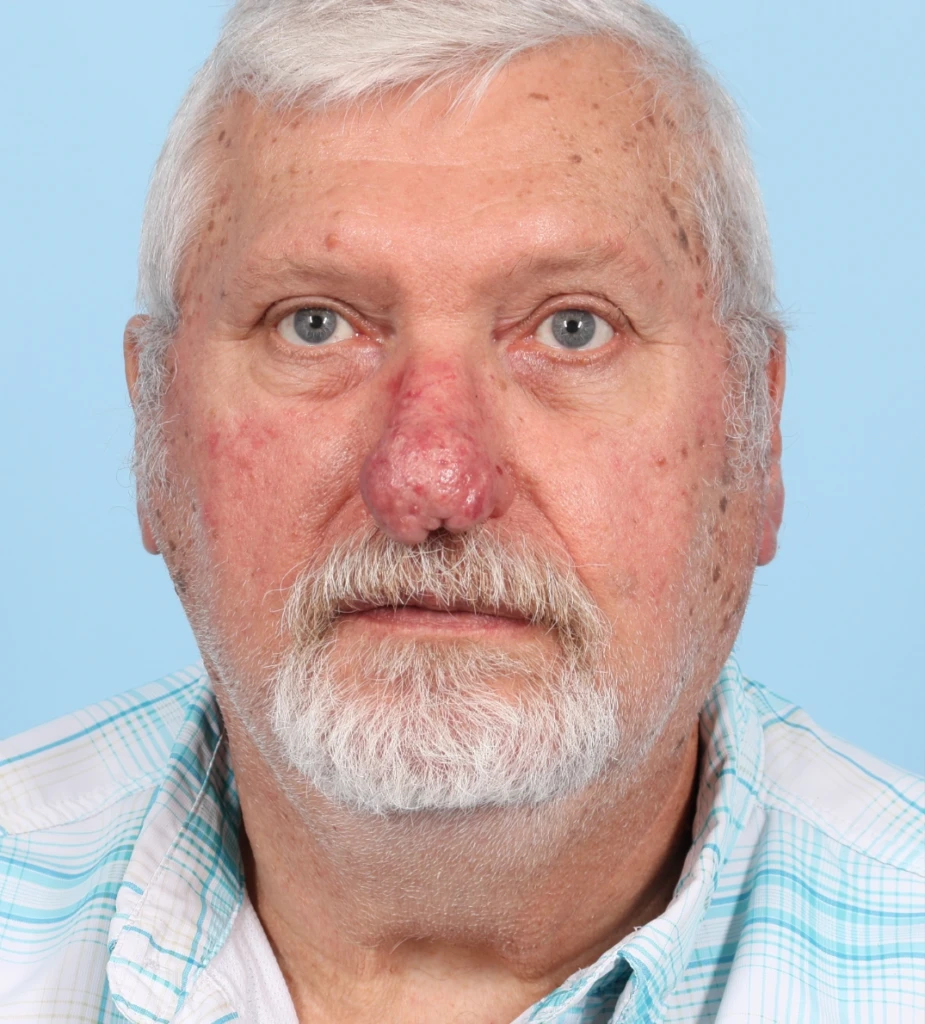 Rhinophyma 2 B