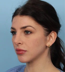 Rhinoplasty 10 A
