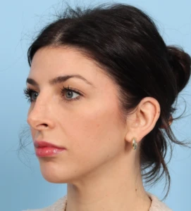 Rhinoplasty 10 B