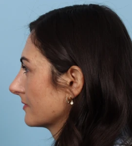 Rhinoplasty 12 A