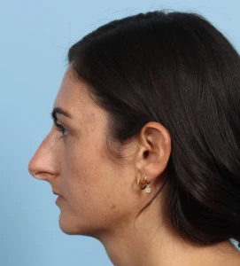 Rhinoplasty 12 B