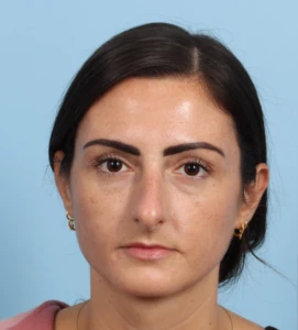 Rhinoplasty 13 B