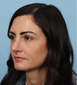 Rhinoplasty 14 A