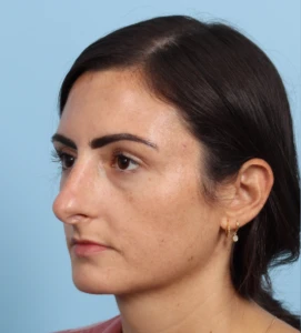 Rhinoplasty 14 B