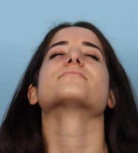 Rhinoplasty 15 A