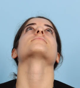 Rhinoplasty 15 B