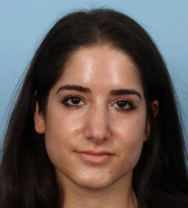 Rhinoplasty 16 A