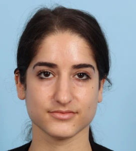 Rhinoplasty 16 B