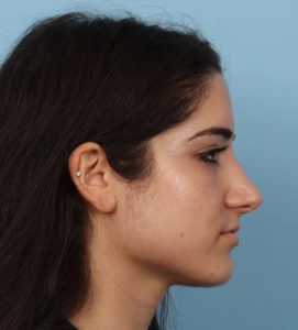 Rhinoplasty 18 A