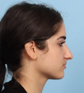 Rhinoplasty 18 B