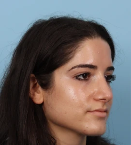 Rhinoplasty 19 A