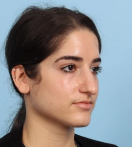 Rhinoplasty 19 B