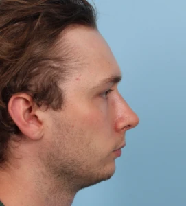 Rhinoplasty 2 A