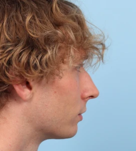 Rhinoplasty 2 B
