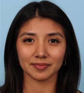 Rhinoplasty 20 A