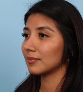 Rhinoplasty 21 A