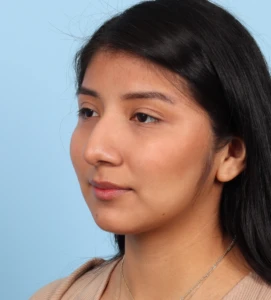 Rhinoplasty 21 B