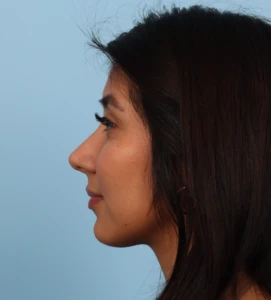 Rhinoplasty 22 A